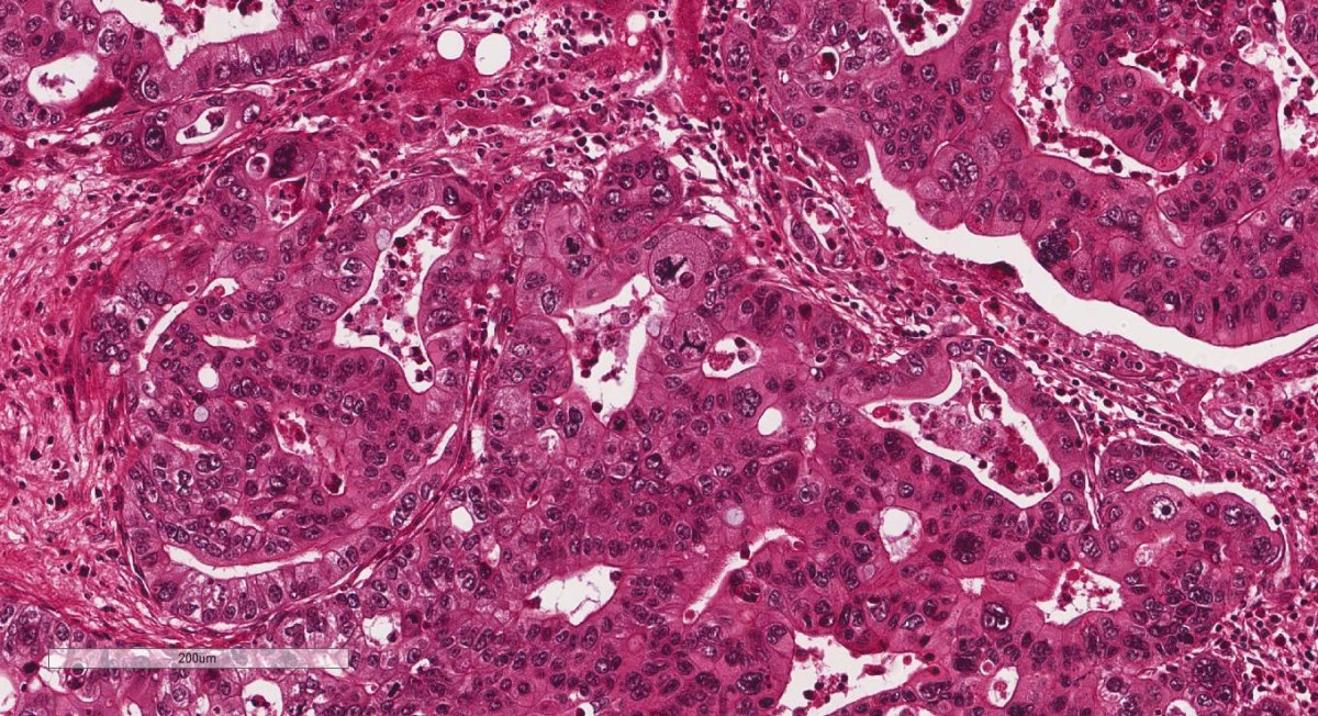 Neoplasia maligna metastática com apoptose